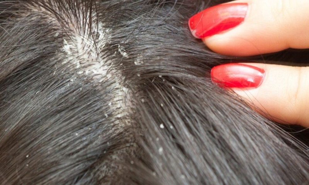 Does An Itching Scalp Have A Relief?