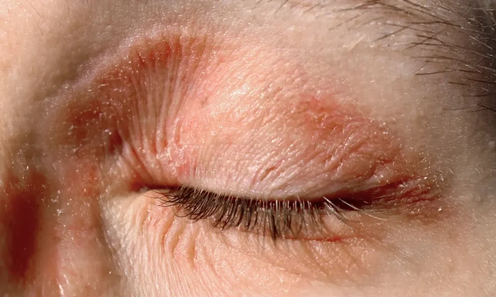 Managing Flaky Eyelids With Suitable Eczema Cream Formulations